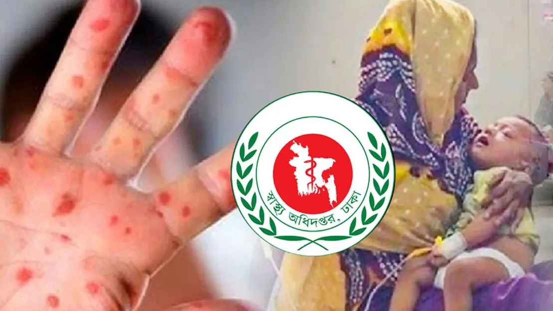 হাম উপসর্গে আরও ৫ শিশুর মৃত্যু