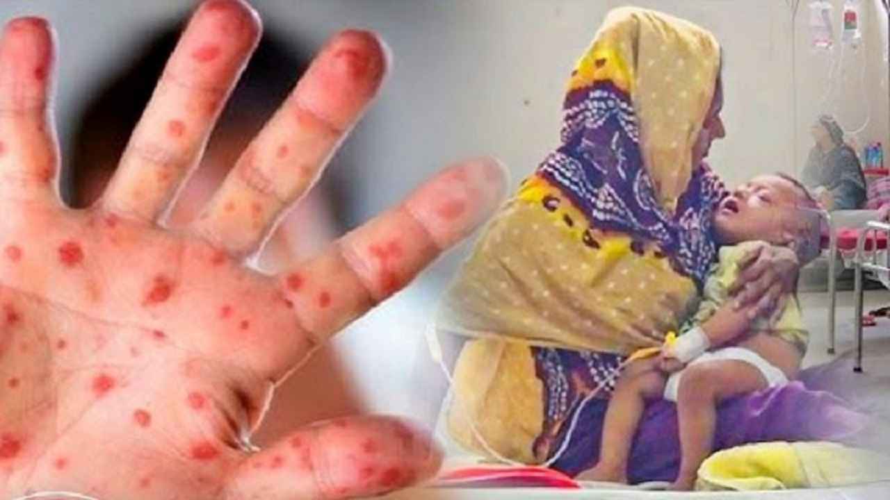 ২৪ ঘণ্টায় ১২ শিশুর মৃত্যু, আতঙ্ক বাড়াচ্ছে হাম