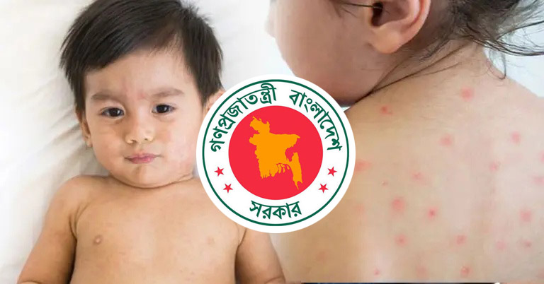 হাম ও উপসর্গে একদিনে আরও ৬ মৃত্যু